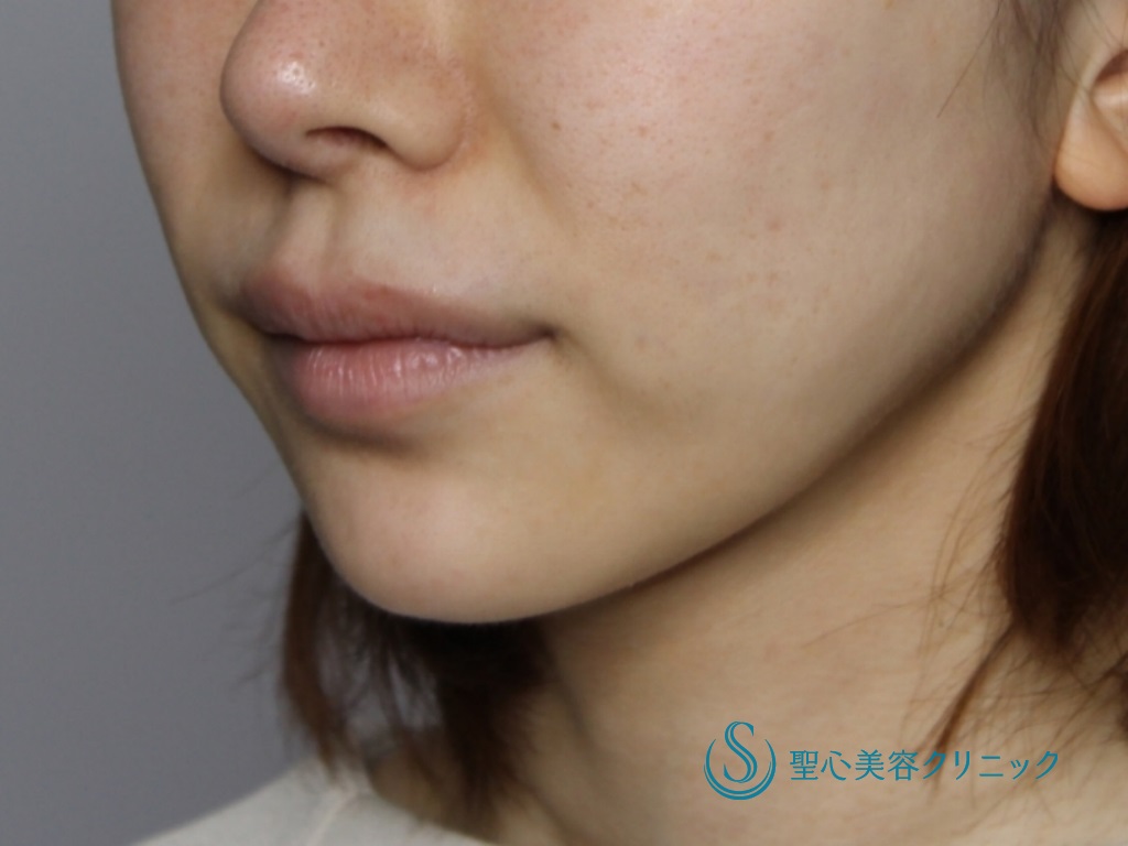 【20代女性・口元～フェイスラインのたるみを改善】フェイスリフト（1ヶ月後） Before 