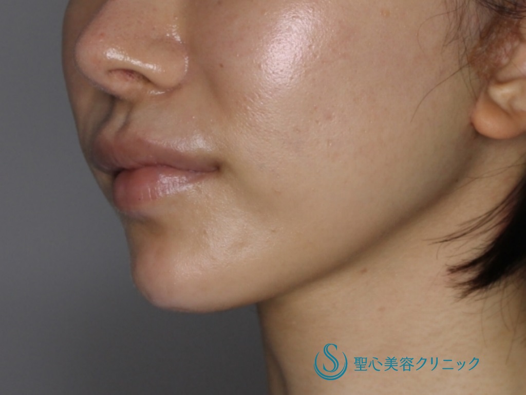 【20代女性・口元～フェイスラインのたるみを改善】フェイスリフト（1ヶ月後） After 