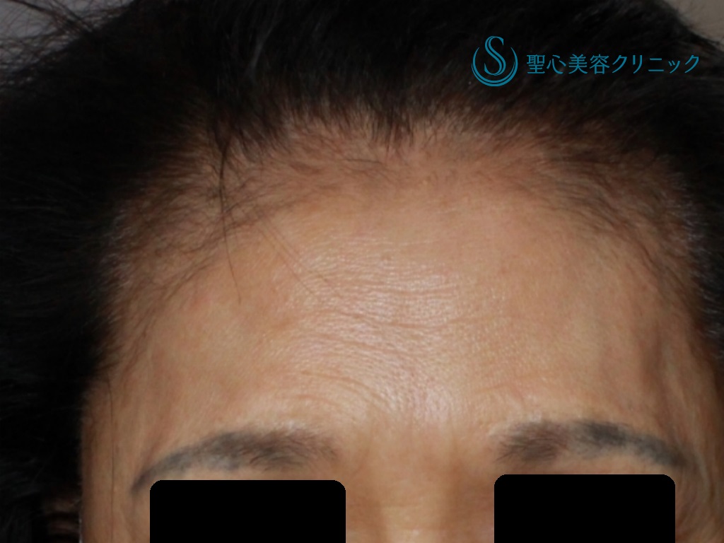 【50代女性・額と眉間の若返り】プレミアムPRP皮膚再生療法（1年後） Before 