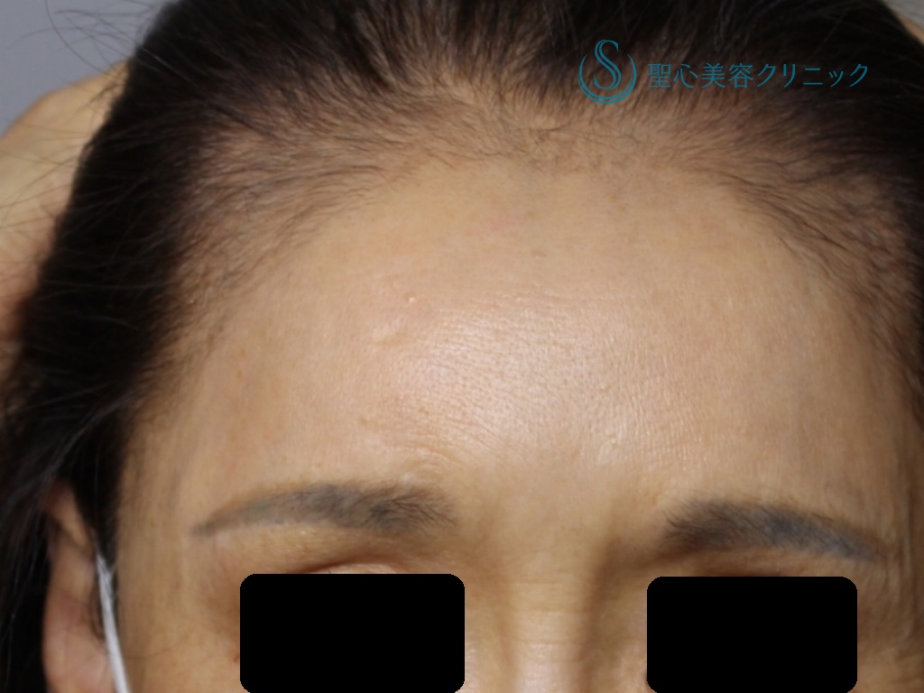 【50代女性・額と眉間の若返り】プレミアムPRP皮膚再生療法（1年後） After 