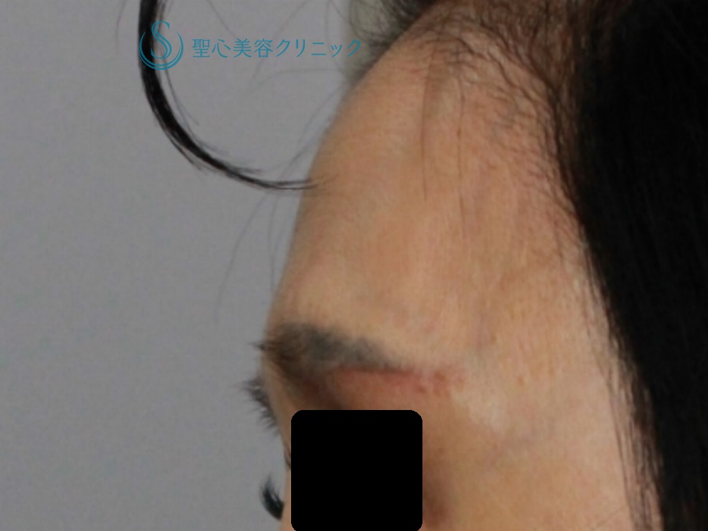 【50代女性・額と眉間の若返り】プレミアムPRP皮膚再生療法（1年後） Before 