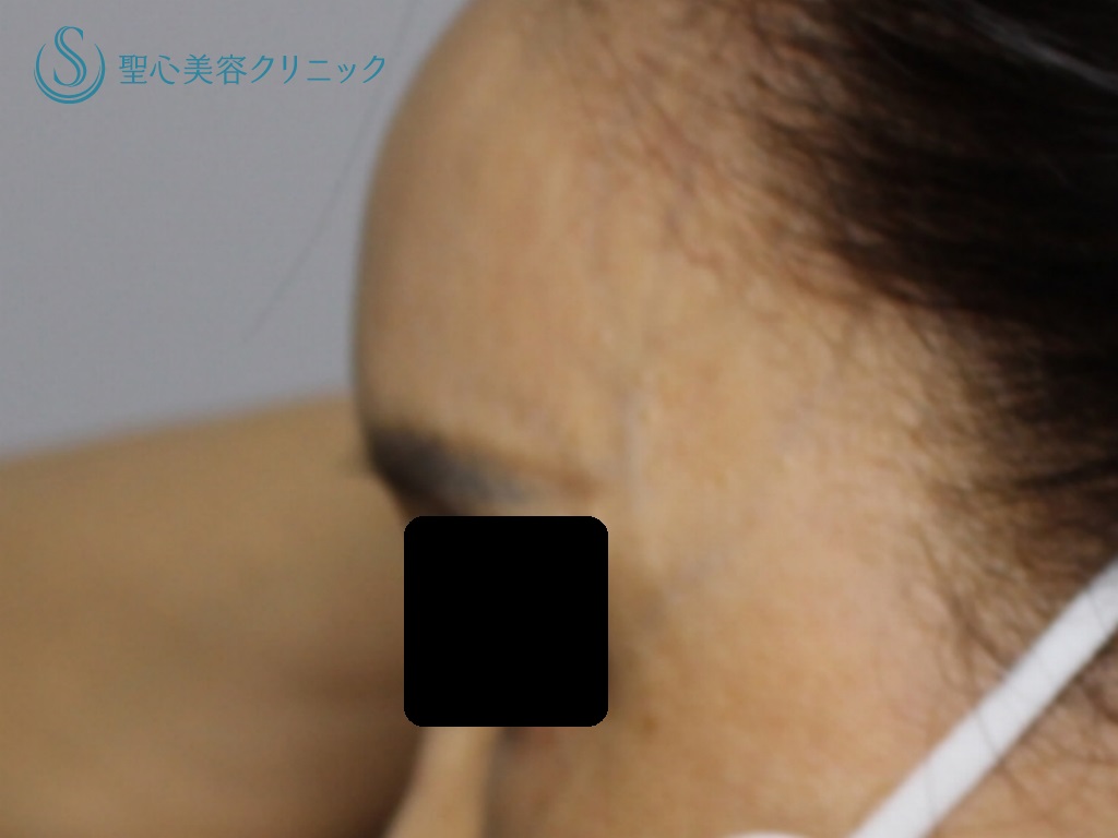 【50代女性・額と眉間の若返り】プレミアムPRP皮膚再生療法（1年後） After 