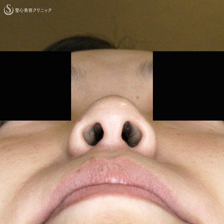【20代女性・鼻の穴が見えない「忘れ鼻」に】小鼻縮小術+α法「Ver.5」（3年後） After 