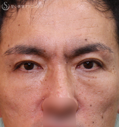 【50代男性・アンチエイジング】眉下切開＆プレミアムPRP皮膚再生療法（1年7ヶ月後） After 
