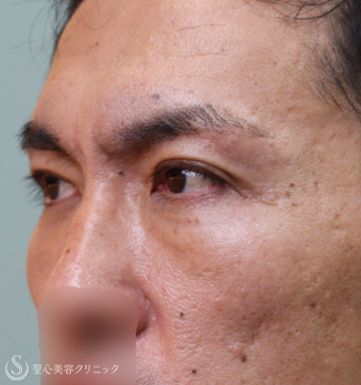 【50代男性・アンチエイジング】眉下切開＆プレミアムPRP皮膚再生療法（1年7ヶ月後） After 