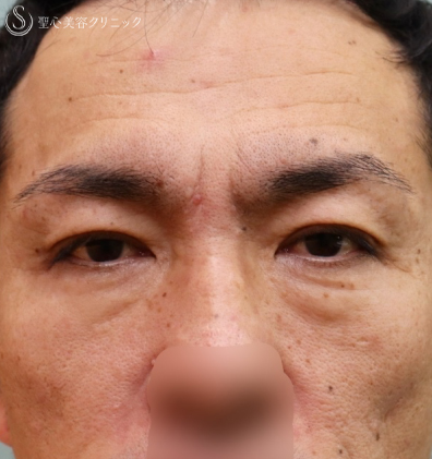 【50代男性・アンチエイジング】眉下切開＆プレミアムPRP皮膚再生療法（1年7ヶ月後） Before 
