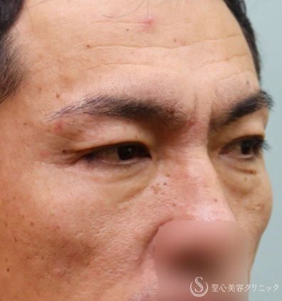 【50代男性・アンチエイジング】眉下切開＆プレミアムPRP皮膚再生療法（1年7ヶ月後） Before 