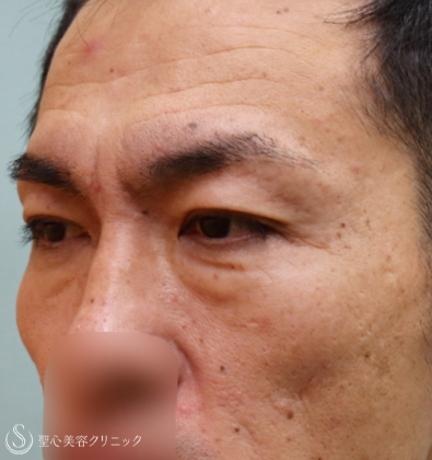【50代男性・アンチエイジング】眉下切開＆プレミアムPRP皮膚再生療法（1年7ヶ月後） Before 