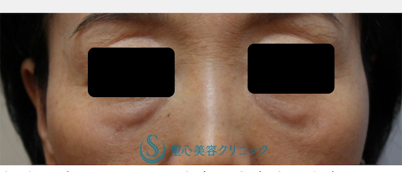【60代女性・目の上下】プレミアムPRP皮膚再生療法（9年後） Before 