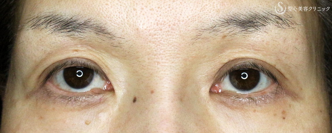 【50代女性・くぼみ目の改善効果も】切らない眼瞼下垂+α法（6年後） After 