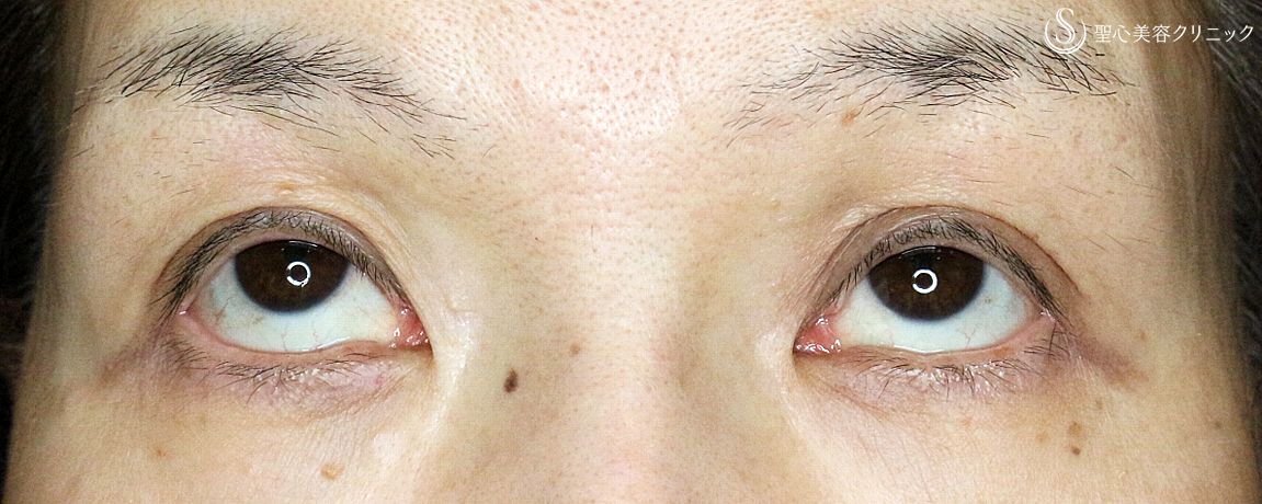 【50代女性・くぼみ目の改善効果も】切らない眼瞼下垂+α法（6年後） After 