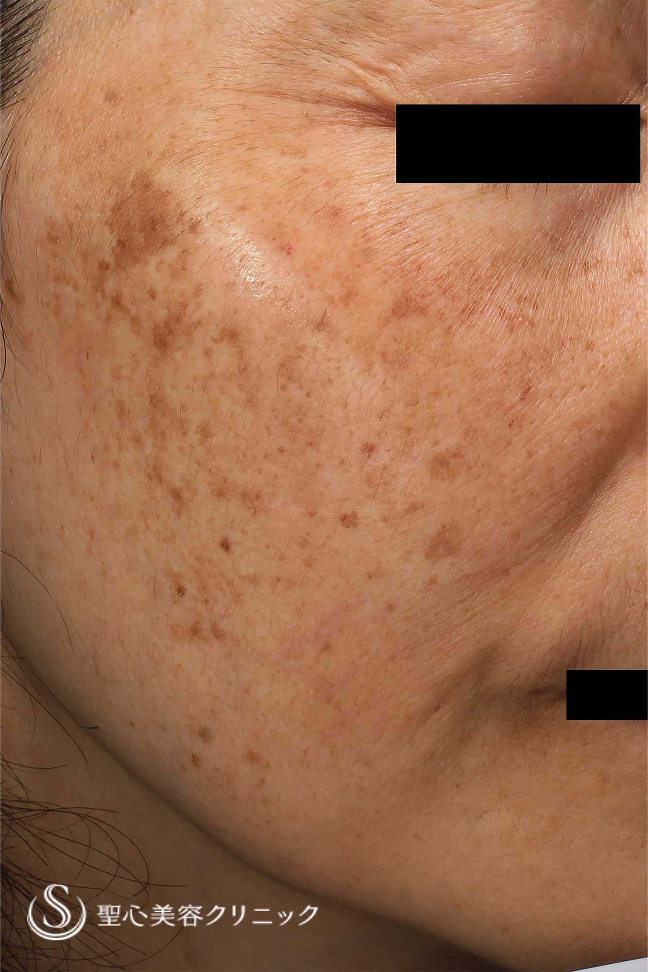 【40代女性・頬のシミ】CellecV（セレックV）（1ヶ月後） Before 