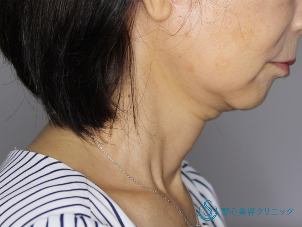 【60代女性・たるみが気になる】あご下～ネックリフト（あご下ベイザー脂肪吸引併用）（1ヶ月後） After 