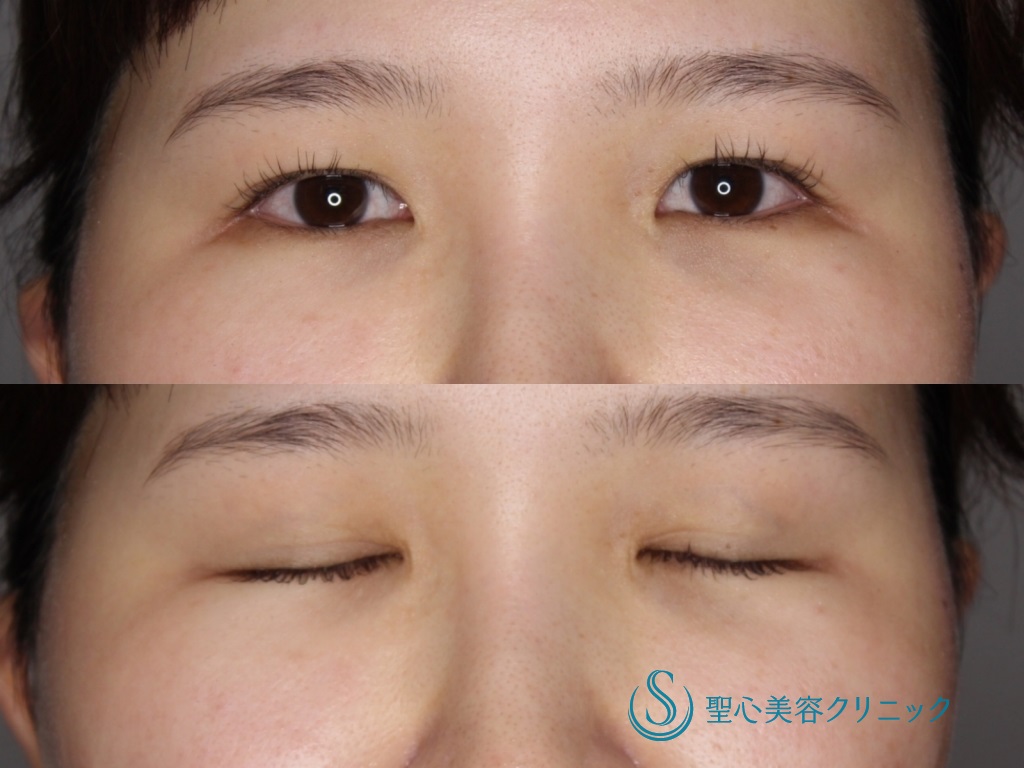 【20代女性・幅広の平行二重に】二重埋没法（マイクロメソッド+α）（3日後） Before 