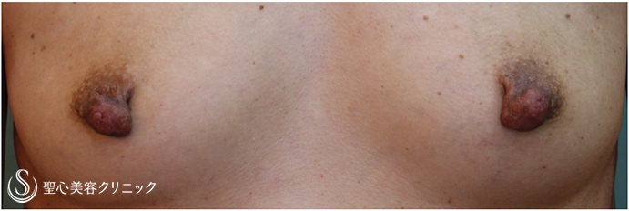 【40代女性・下垂した乳頭の修正】乳頭縮小（１ヶ月後） Before 