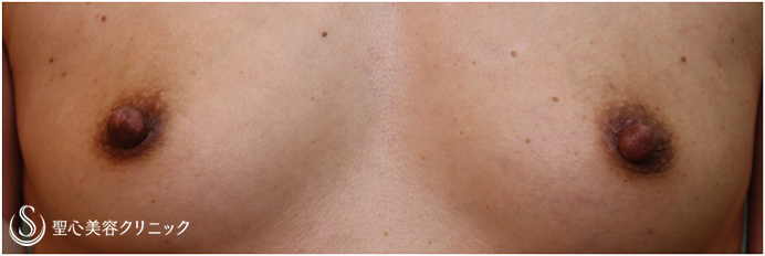 【40代女性・下垂した乳頭の修正】乳頭縮小（１ヶ月後） After 