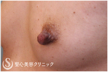 【40代女性・下垂した乳頭の修正】乳頭縮小（１ヶ月後） Before 
