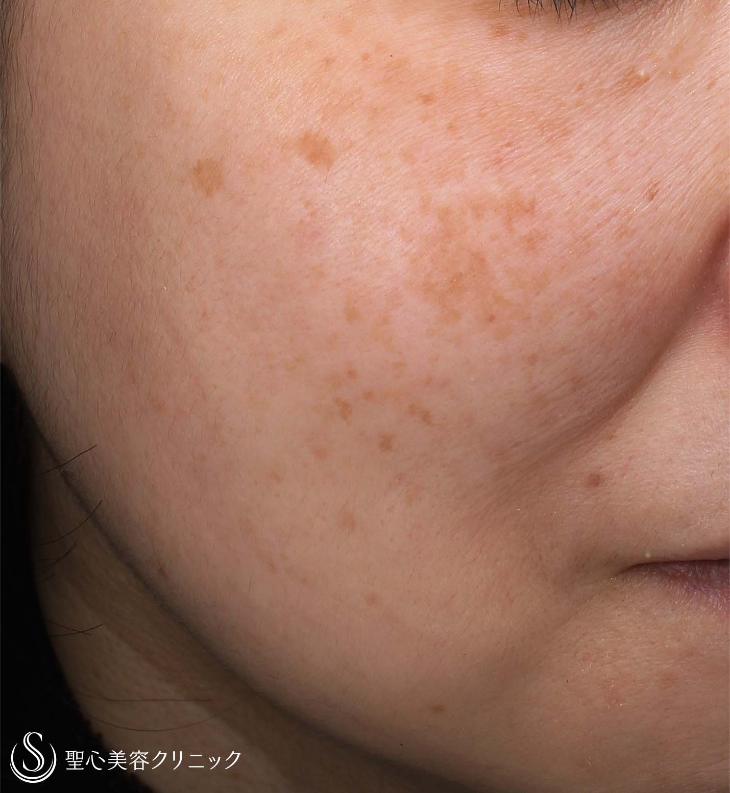 【50代女性・しみ】セレックV（1ヶ月後） Before 