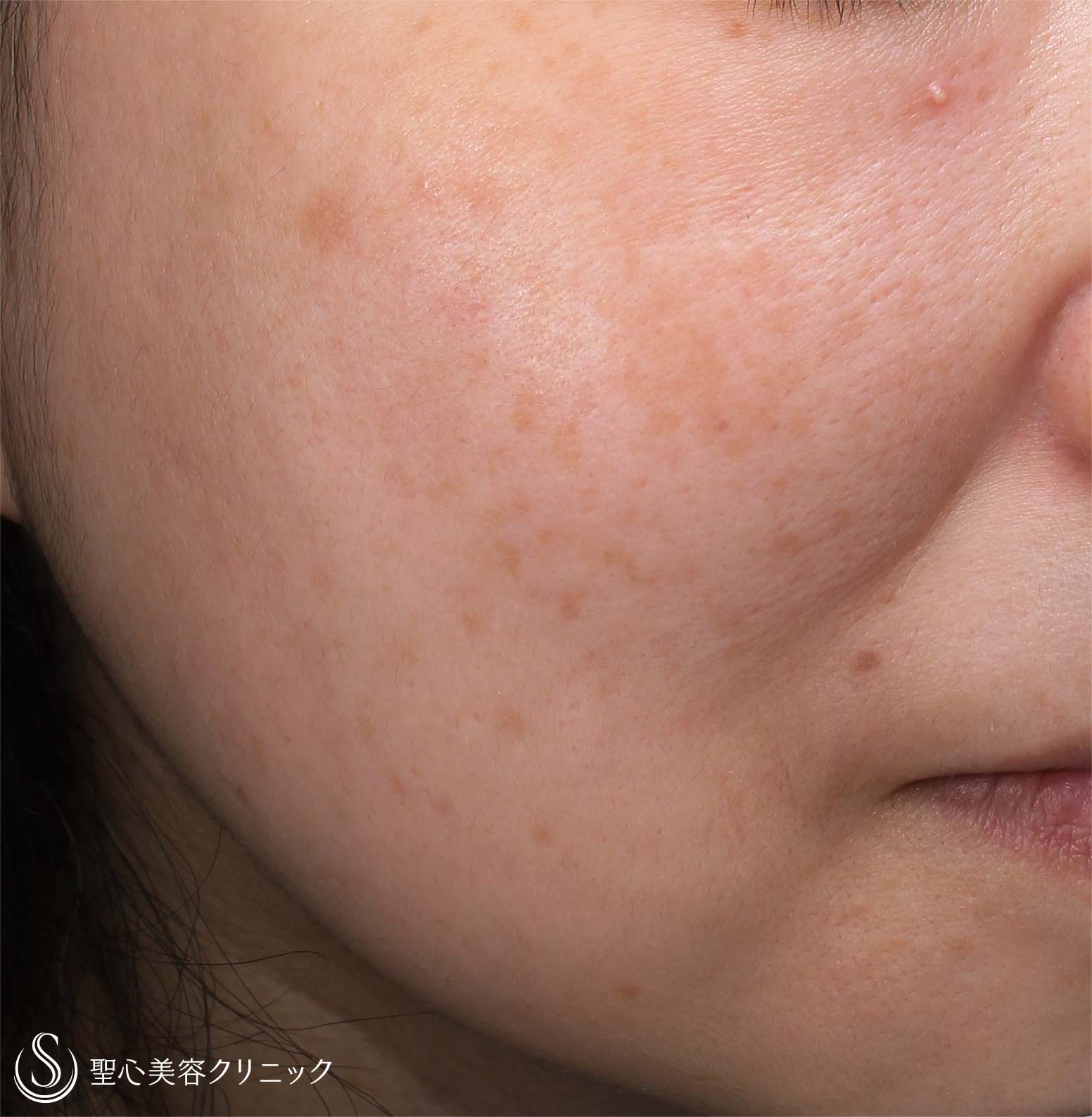 【50代女性・しみ】セレックV（1ヶ月後） After 