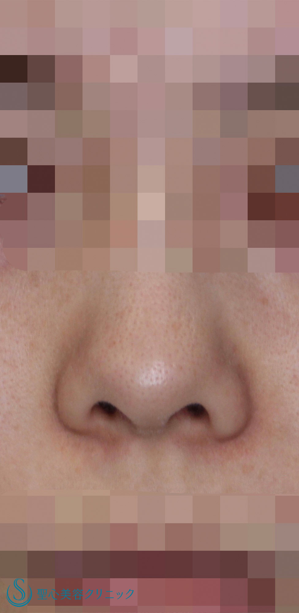 【20代女性・鼻の穴を目立ちにくくしたい！！】鼻孔縁下降術（術後6ヶ月） Before 