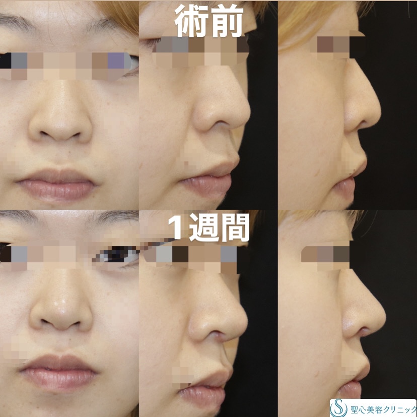 【20代女性・鼻先を細く高く】鼻尖縮小＋鼻尖形成+ストラット法（鼻柱補強術）（1週間後） Before 