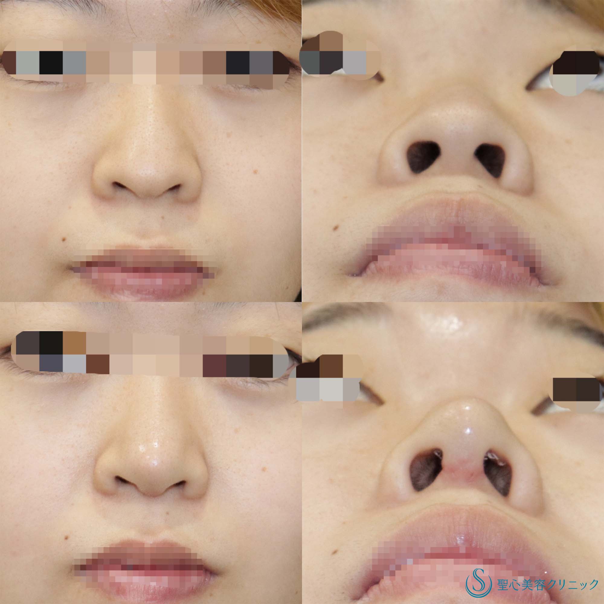 【20代女性・鼻先を細く高く】鼻尖縮小＋鼻尖形成+ストラット法（鼻柱補強術）（1週間後） After 
