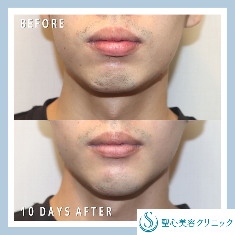 【20代男性・顎を整える】あごプロテーゼ（10日後） Before 