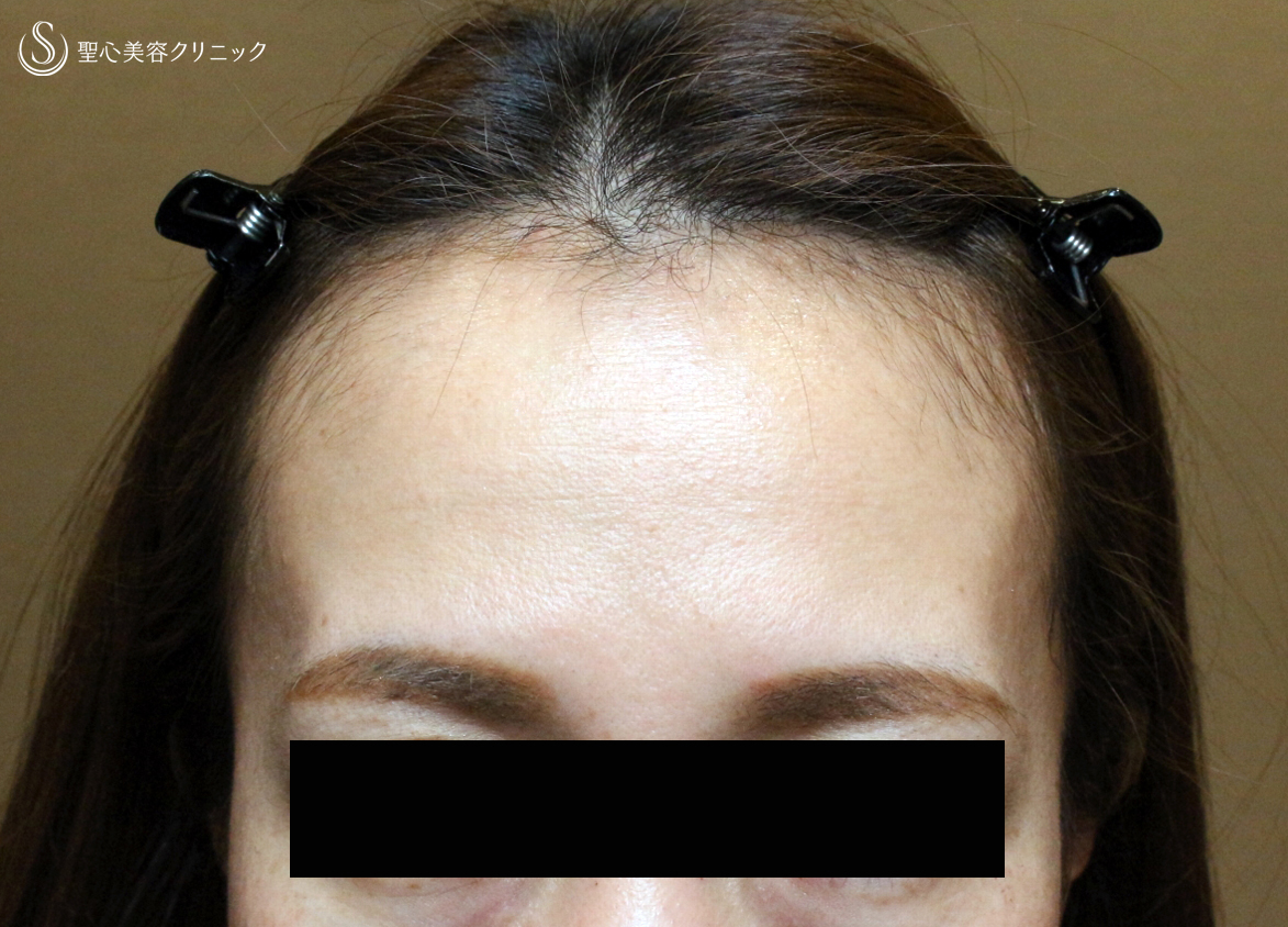 【40代女性・こめかみ＆おでこを美しく】プレミアムPRP皮膚再生療法（8ヶ月後） Before 