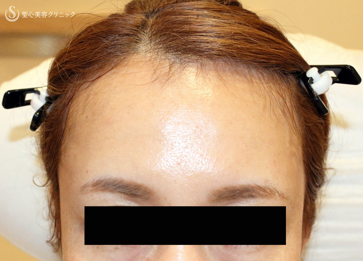 【40代女性・こめかみ＆おでこを美しく】プレミアムPRP皮膚再生療法（8ヶ月後） After 