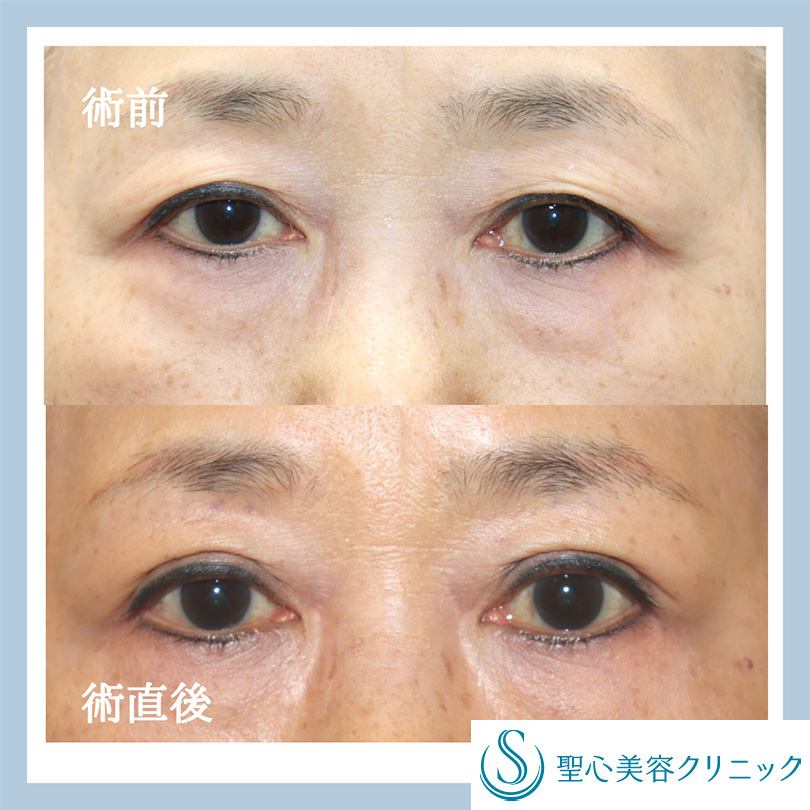 【60代女性・二重に】二重術（埋没法）：マイクロメソッド+α（術直後） Before 