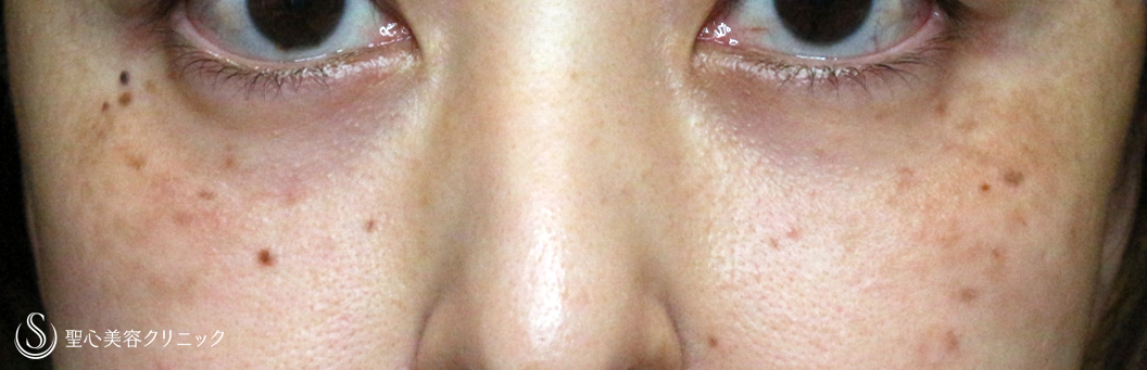 【40代女性・目の下の赤グマを切らずに解消】経結膜下脱脂術単独（1ヶ月半後） After 