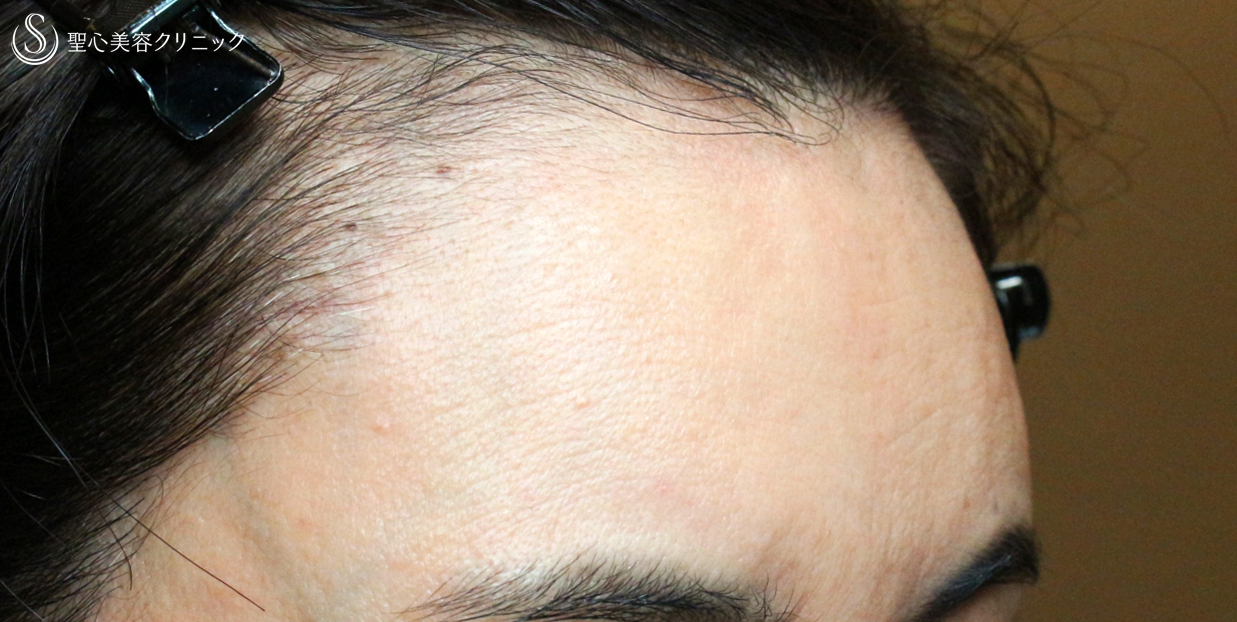 【40代女性・額へ注入治療の長期経過】プレミアムPRP皮膚再生療法（11年後） After 
