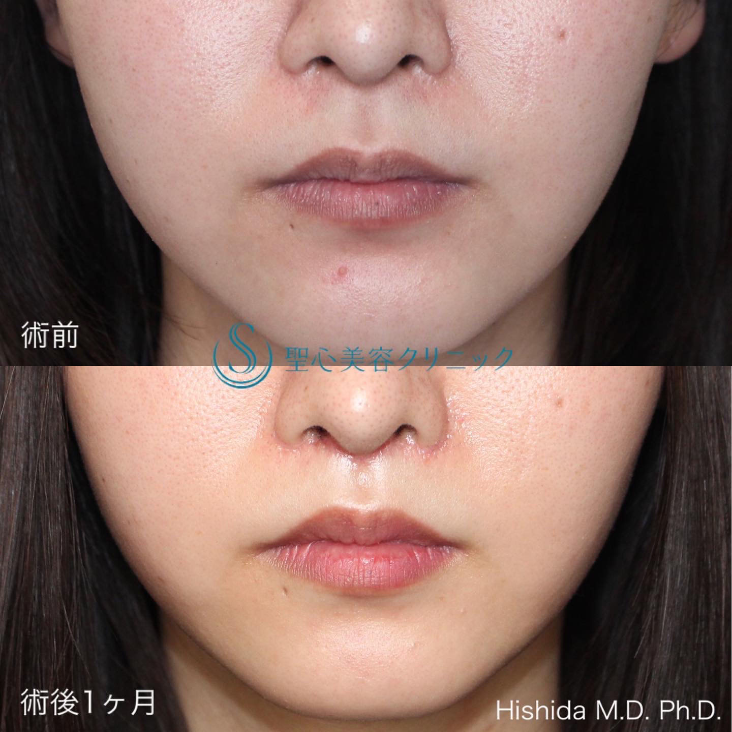 【20代女性・人中を短くしたい！！】リップリフト（人中短縮術）（術後1ヶ月） After 