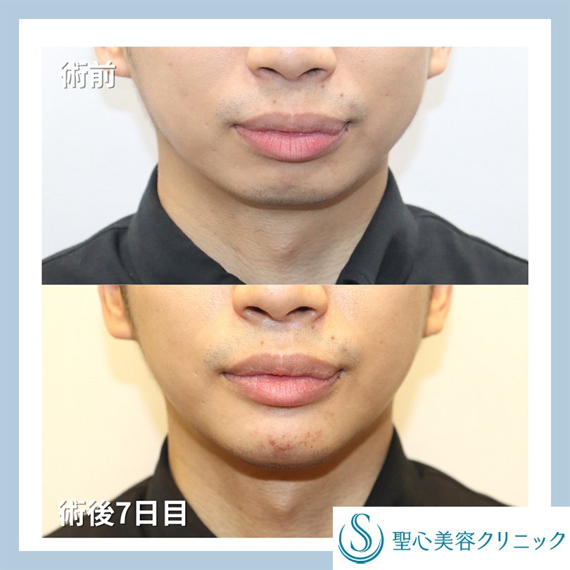 【30代男性・Eラインを整える】あごプロテーゼ（1週間後） Before 
