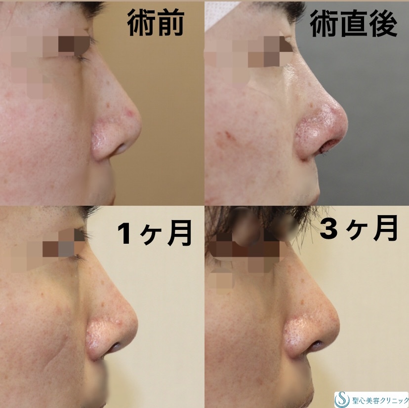 【20代男性・アップノーズを解消】鼻尖縮小＋形成術（耳介軟骨）（術直後～3ヶ月） After 