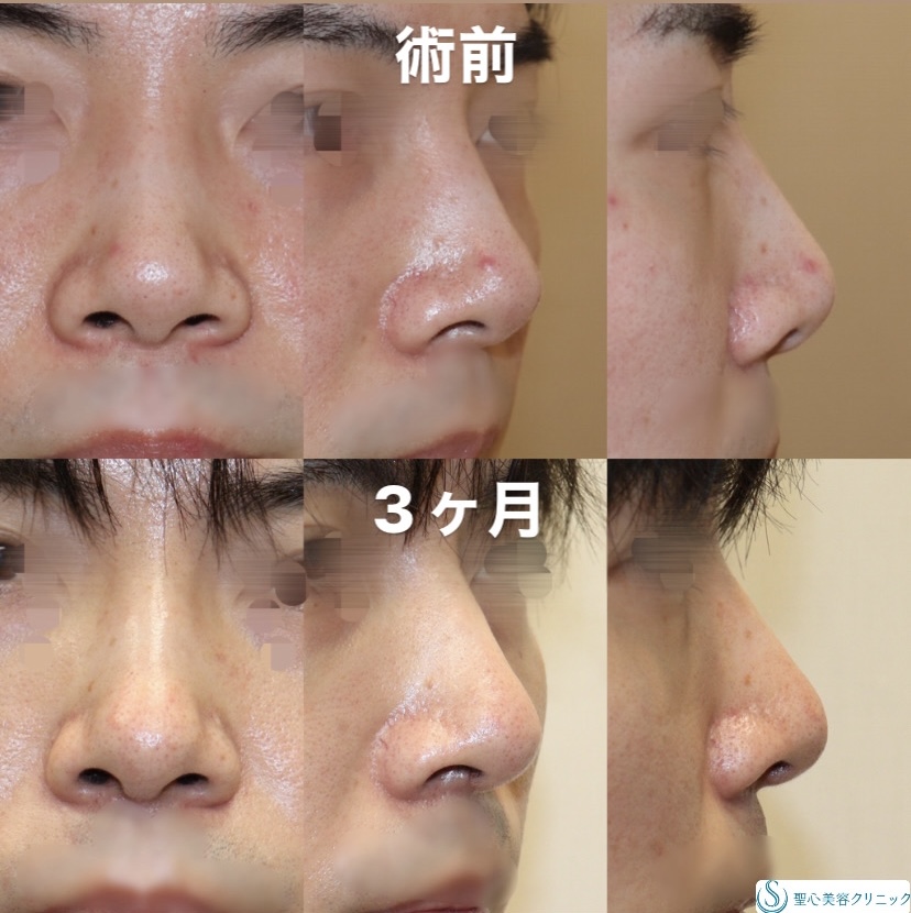 【20代男性・アップノーズを解消】鼻尖縮小＋形成術（耳介軟骨）（術直後～3ヶ月） Before 