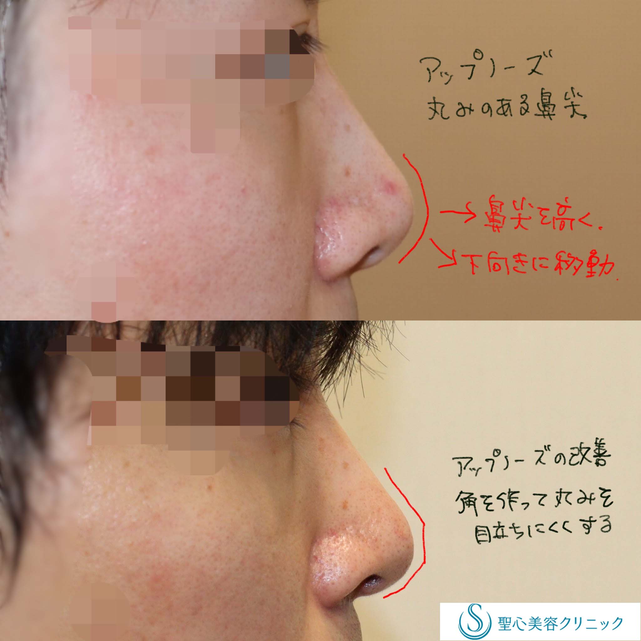 【20代男性・アップノーズを解消】鼻尖縮小＋形成術（耳介軟骨）（術直後～3ヶ月） After 