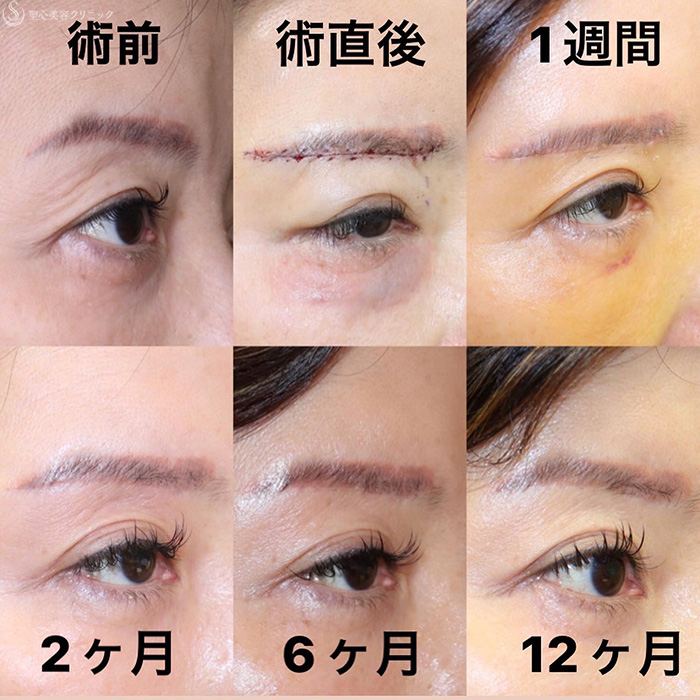 【50代女性・「眉下切開の傷跡はいったいどうなるのか」術後１年の記録】眉下切開法（眉下リフト）（1年後） After 