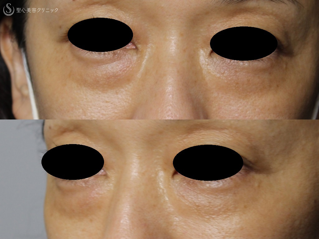 【40代女性・目の下の膨らみと弛み、クマの改善】目の下の脱脂+プレミアムPRP皮膚再生療法（1か月後） Before 