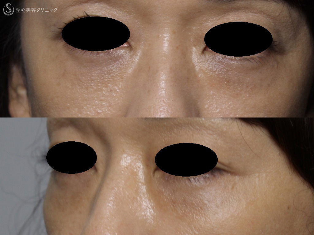 【40代女性・目の下の膨らみと弛み、クマの改善】目の下の脱脂+プレミアムPRP皮膚再生療法（1か月後） After 