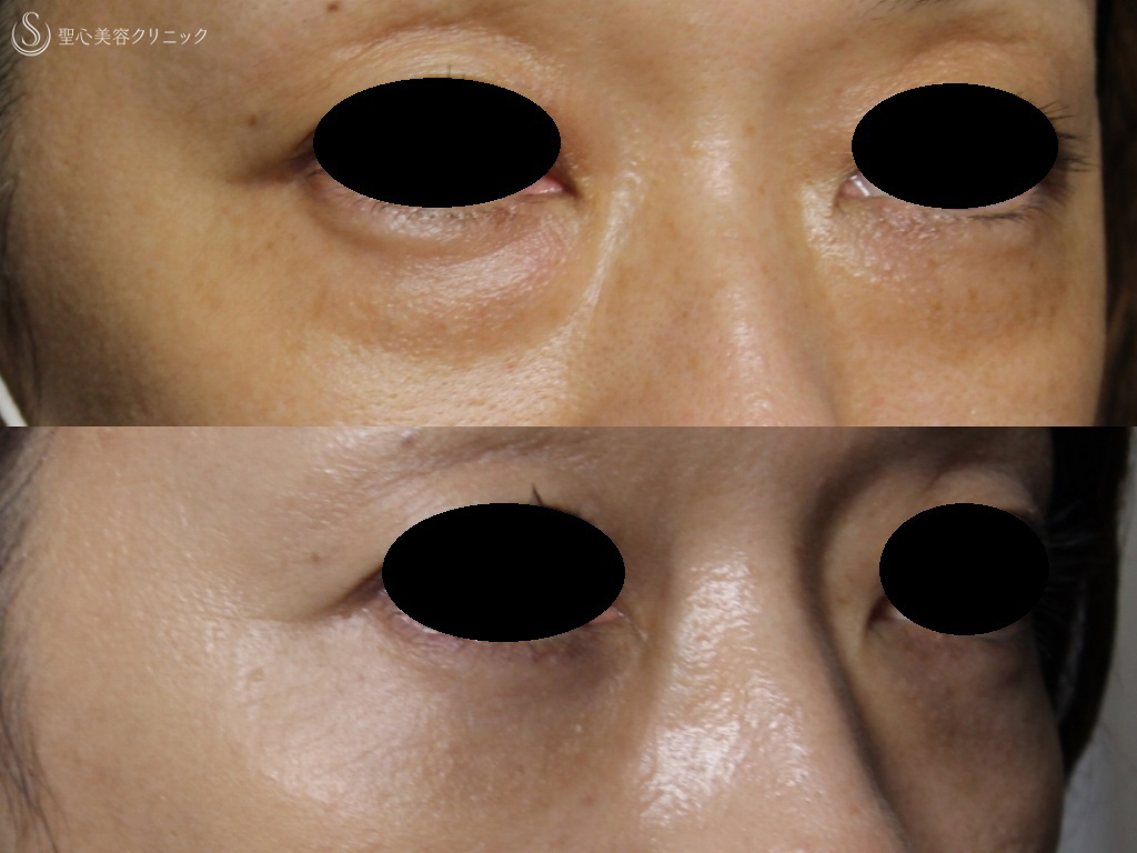 【40代女性・目の下の膨らみと弛み、クマの改善】目の下の脱脂+プレミアムPRP皮膚再生療法（1か月後） After 