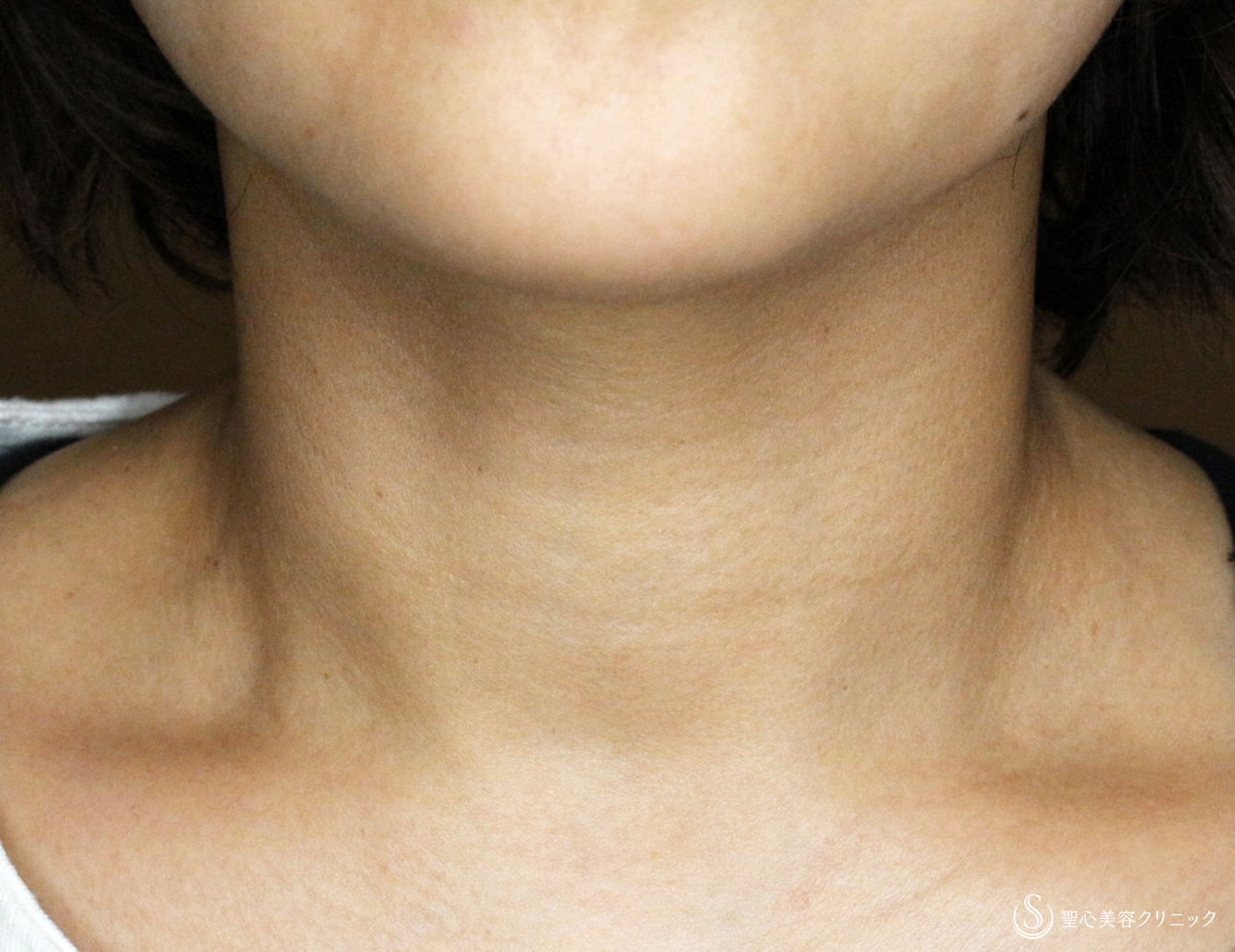 【40代女性・首の浅い横ジワを綺麗にする】プレミアムPRP皮膚再生療法（2年3ヶ月後） Before 