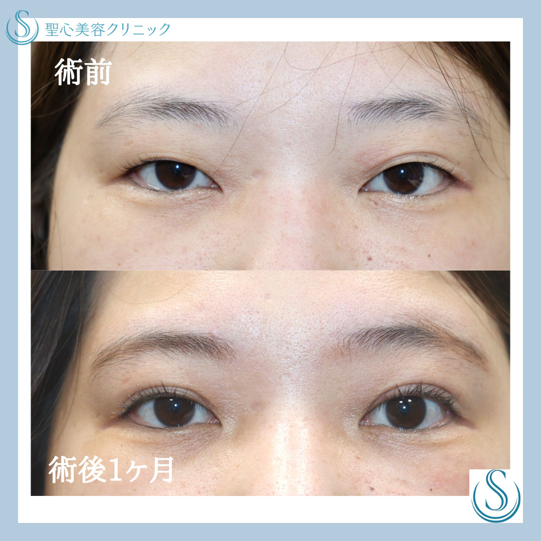 【30代女性・華やかな印象に】二重全切開（術後１ヶ月） Before 