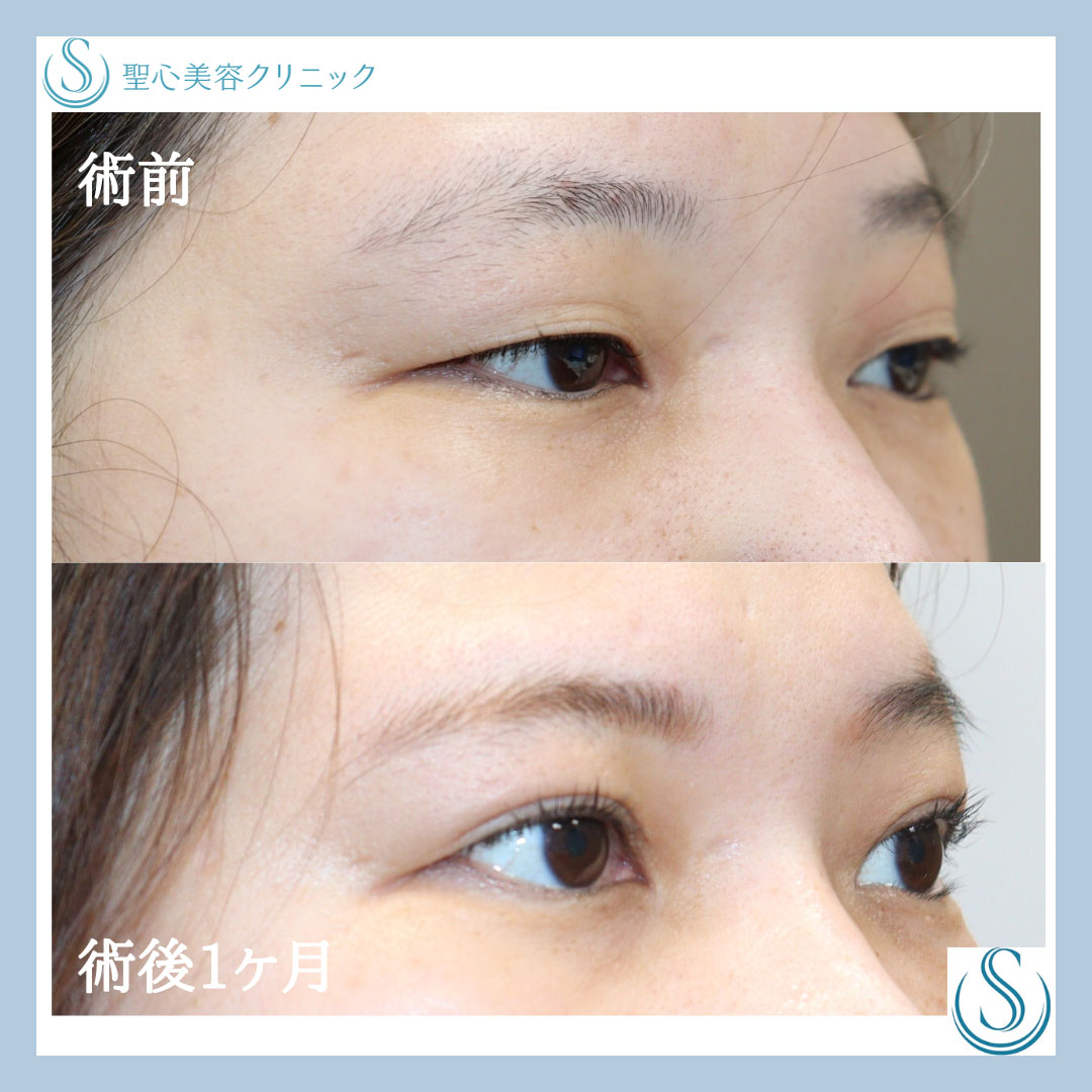 【30代女性・華やかな印象に】二重全切開（術後１ヶ月） After 