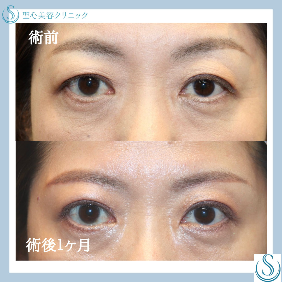 【40代女性・眉下リフトで甦る目力】眉下切開法（眉下リフト）（術後１ヶ月） Before 