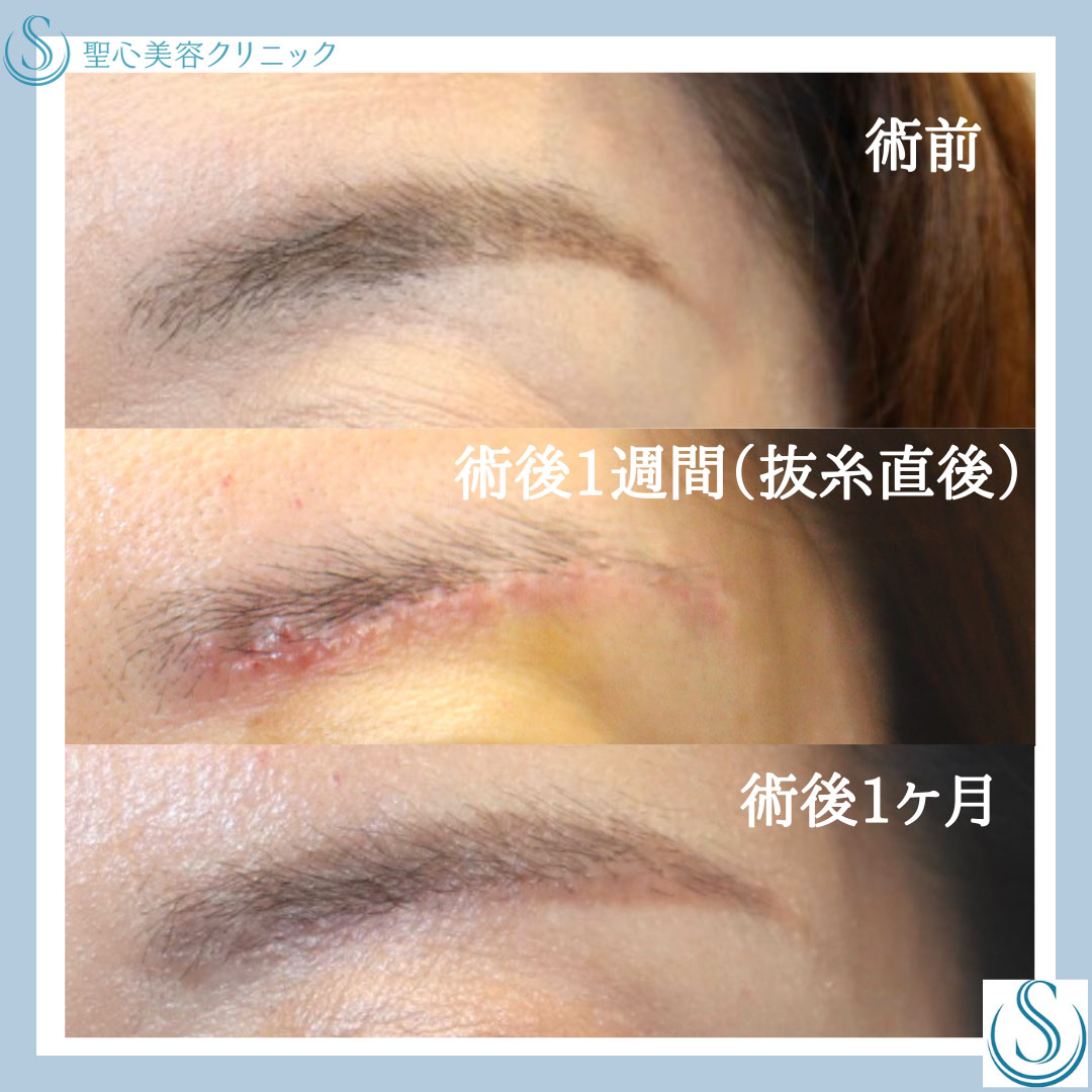 【40代女性・眉下リフトで甦る目力】眉下切開法（眉下リフト）（術後１ヶ月） After 