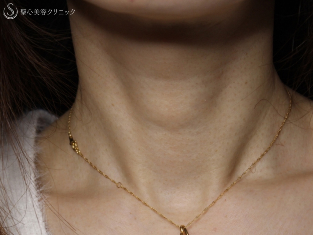 【40代女性・首の横ジワの治療】プレミアムPRP皮膚再生療法（10か月後） Before 