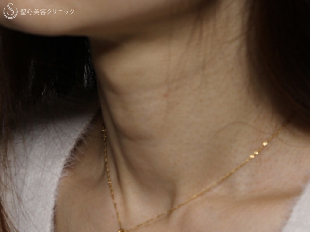 【40代女性・首の横ジワの治療】プレミアムPRP皮膚再生療法（10か月後） Before 