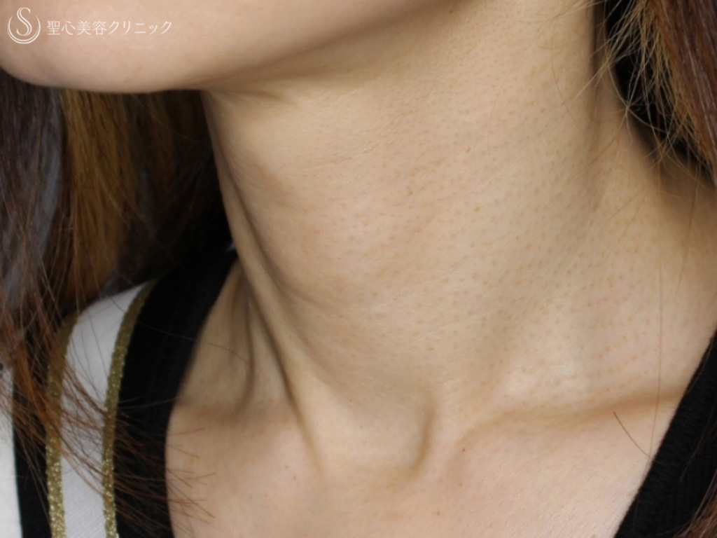 【40代女性・首の横ジワの治療】プレミアムPRP皮膚再生療法（10か月後） After 