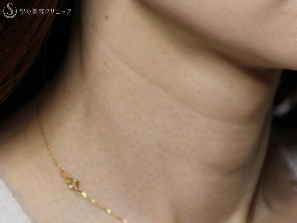 【40代女性・首の横ジワの治療】プレミアムPRP皮膚再生療法（10か月後） Before 